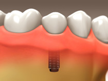 Dental Implants - Scarborough Dentist - Dr. Sara Razmavar - Highland Creek Dental - Illustration 3