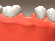Dental Implants - Scarborough Dentist - Dr. Sara Razmavar - Highland Creek Dental - Illustaration 1