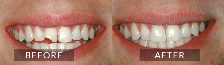 Smile Gallery - Scarborough Dentist - Cosmetic Bonding