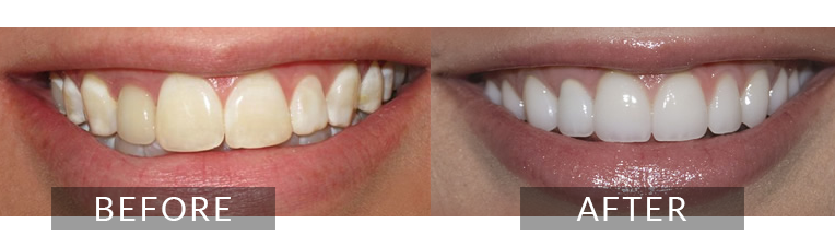 Smile Gallery - Scarborough Dentist - Dental Crown