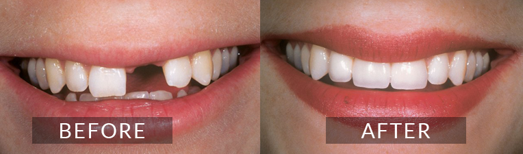 Smile Gallery - Scarborough Dentist - Dental Implants