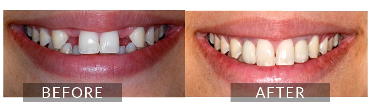 Smile Gallery - Scarborough Dentist - Implants