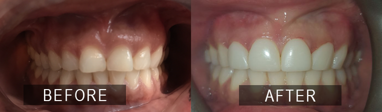 Smile Gallery - Scarborough Dentist - Composite Veneers