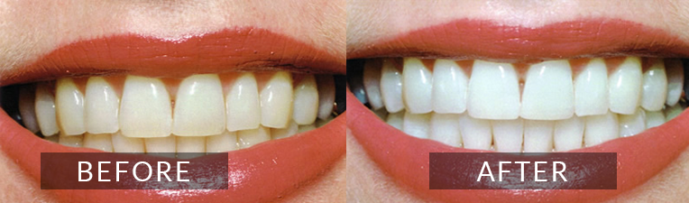 Smile Gallery - Scarborough Dentist - Teeth Whitening
